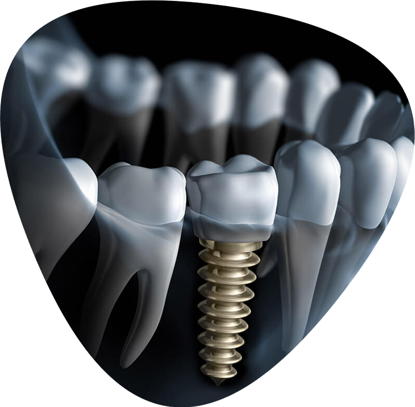 https://www.zeosdental.com/wp-content/uploads/2022/11/img-imp.png